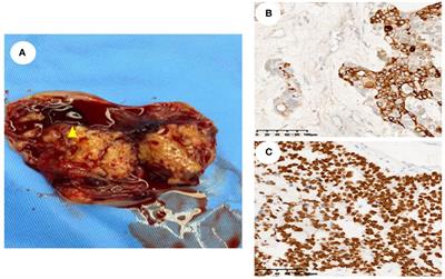 Ultrasonographic and clinicopathological features of pelvic yolk sac tumors in women: a single-center retrospective analysis